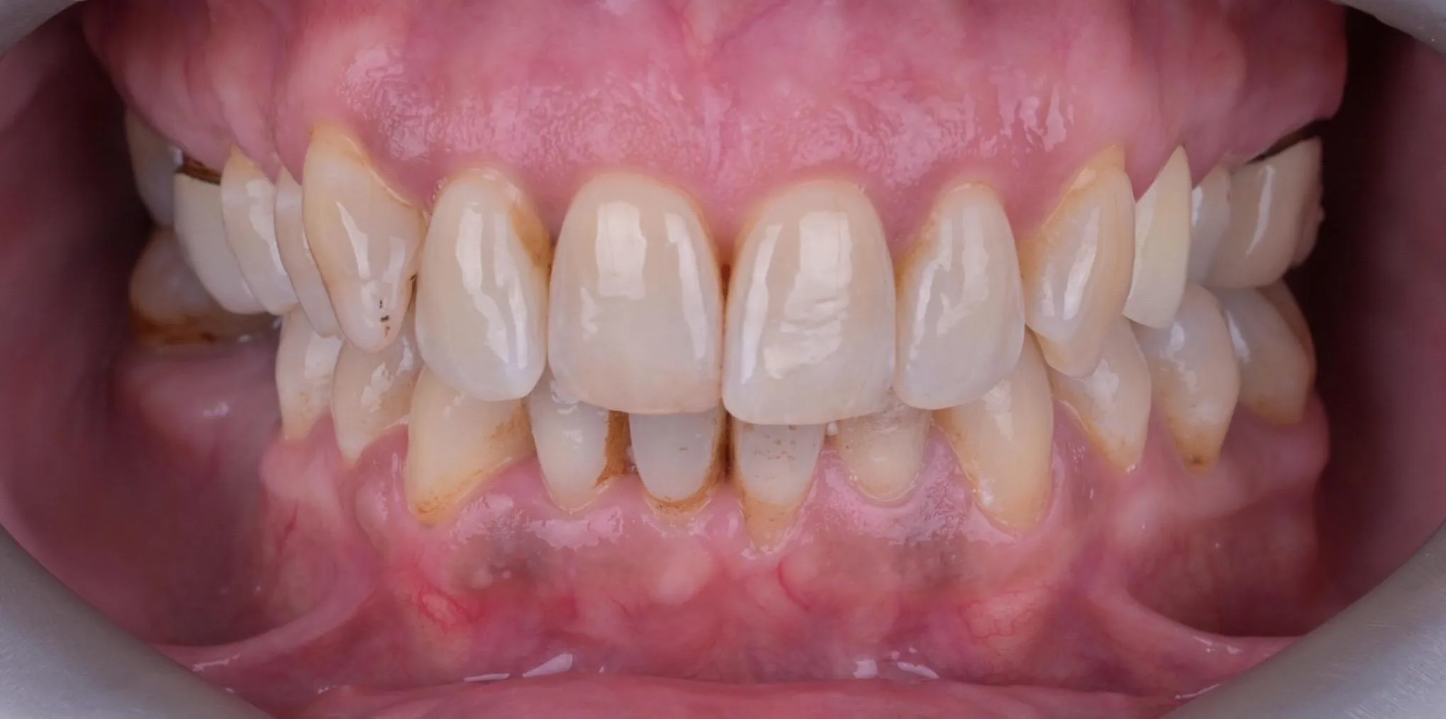 implant ve gülüş tasarımı