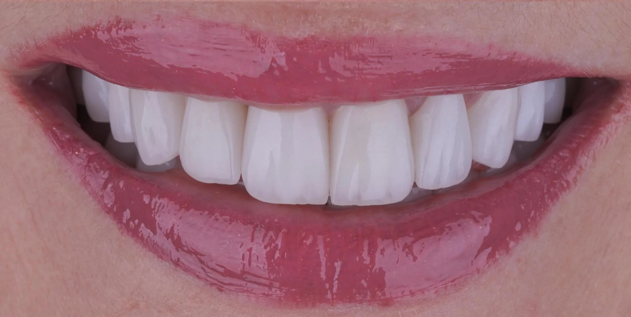 zirkonyum mu veneer mi