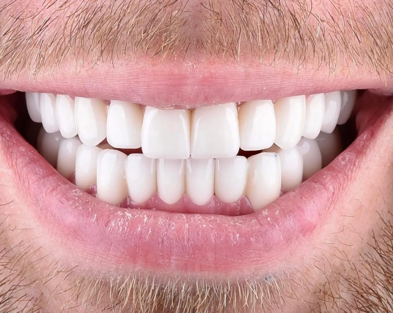 diş beyazlatma ankara